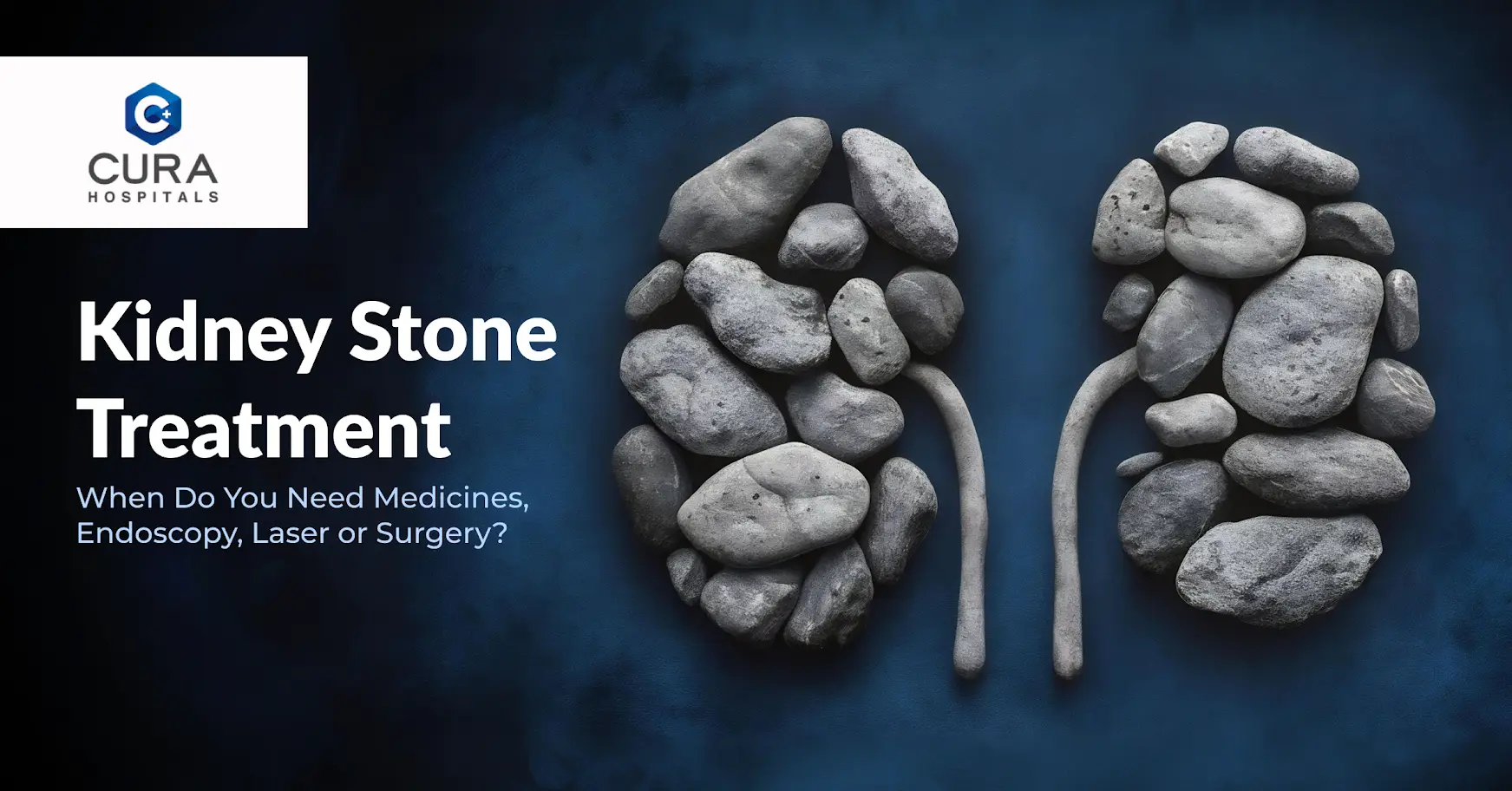 Kidney Stone Treatment: When Do You Need Medicines, Endoscopy, Laser or Surgery?
