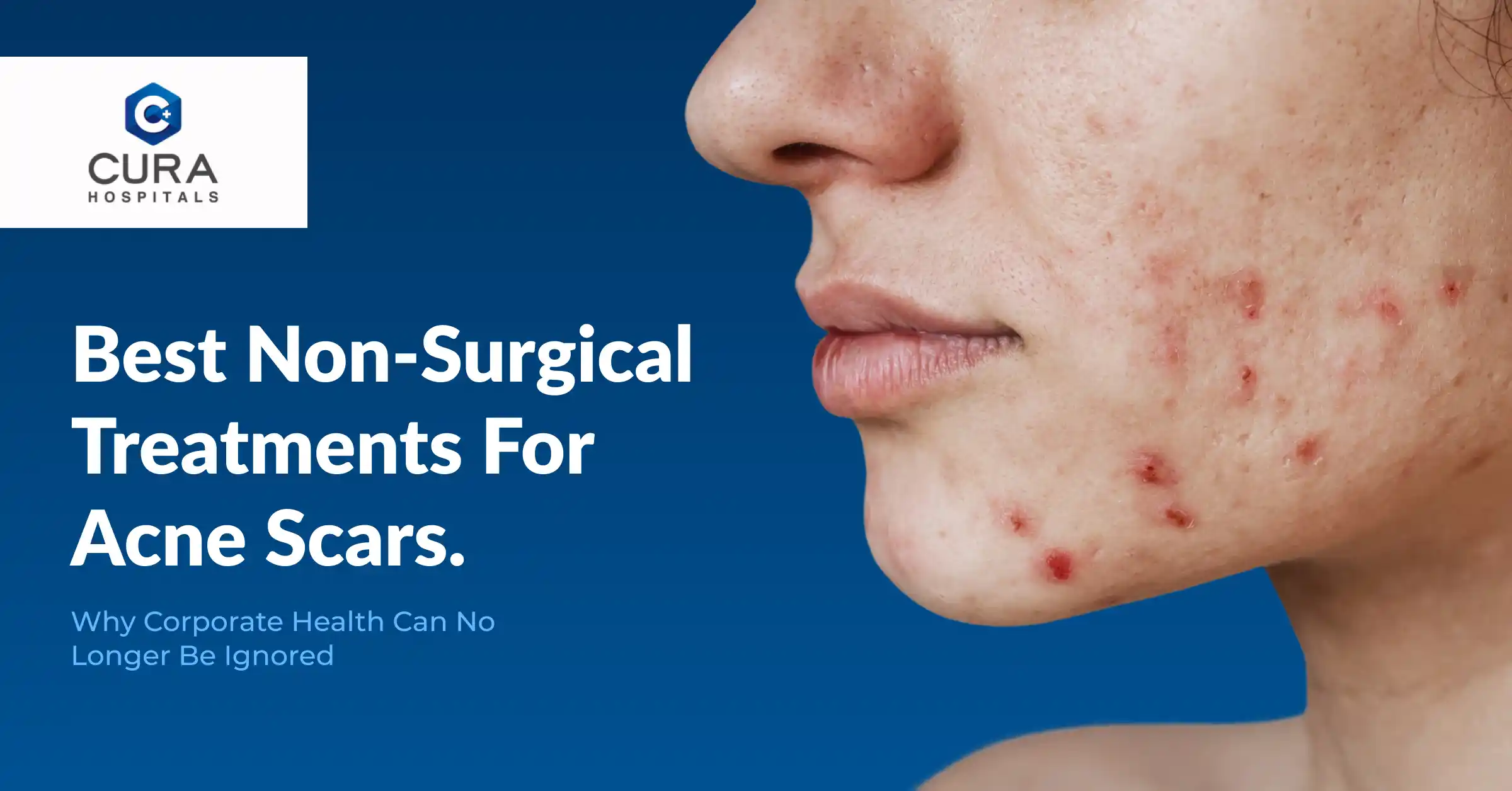 Best Non-Surgical Treatments for Acne Scars: What Actually Works?