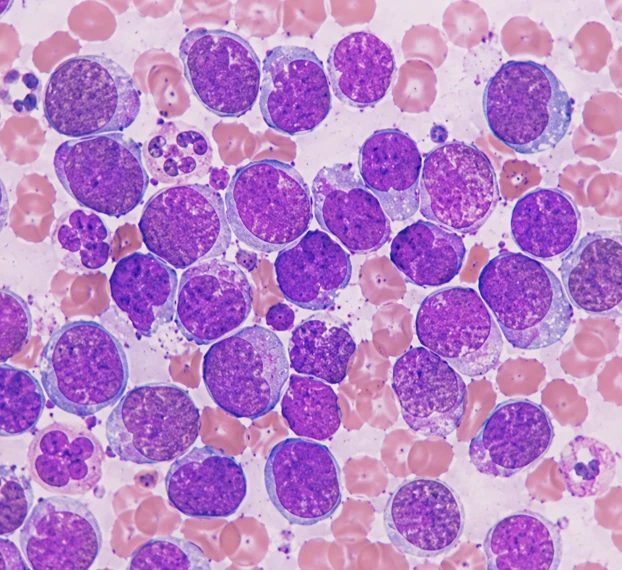 Leukemias