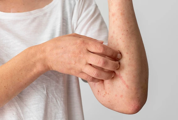 Symptoms  of <em>Allergies</em>
