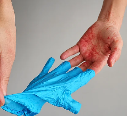 Latex Allergy
