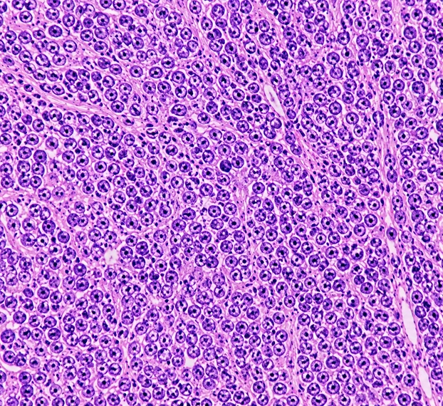 Lymphomas