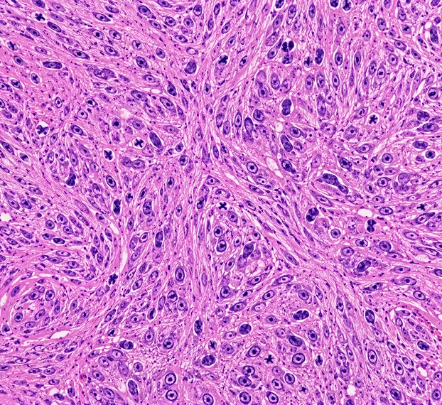 Sarcomas