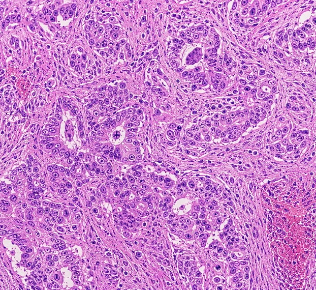 Carcinomas