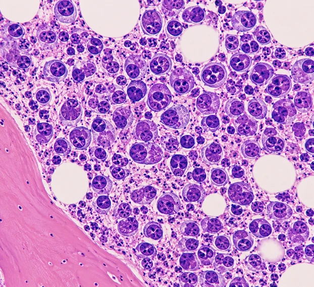Myelomas