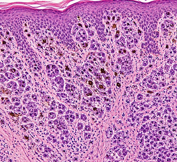 Melanomas