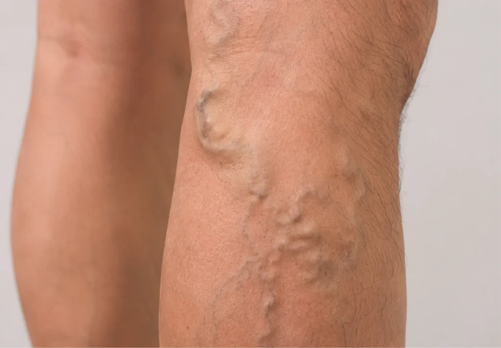 Varicose Veins
