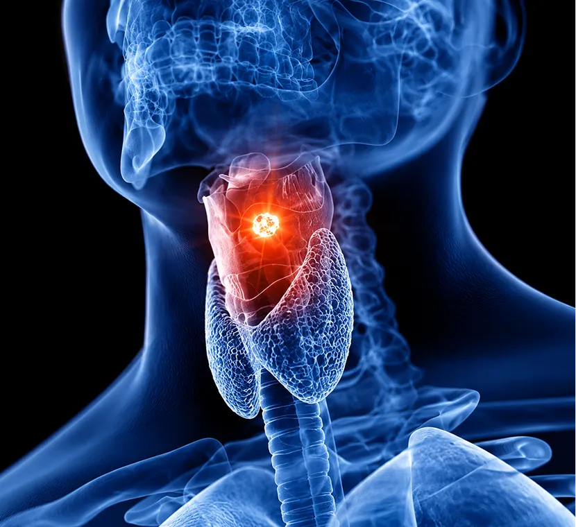 Laryngeal Cancer: 