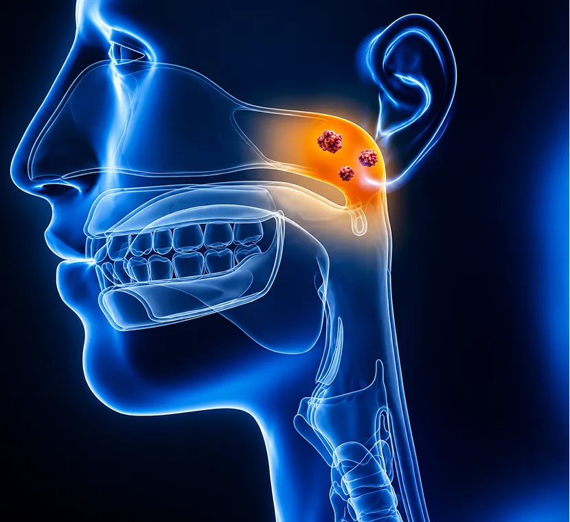 Nasopharyngeal Cancer: 