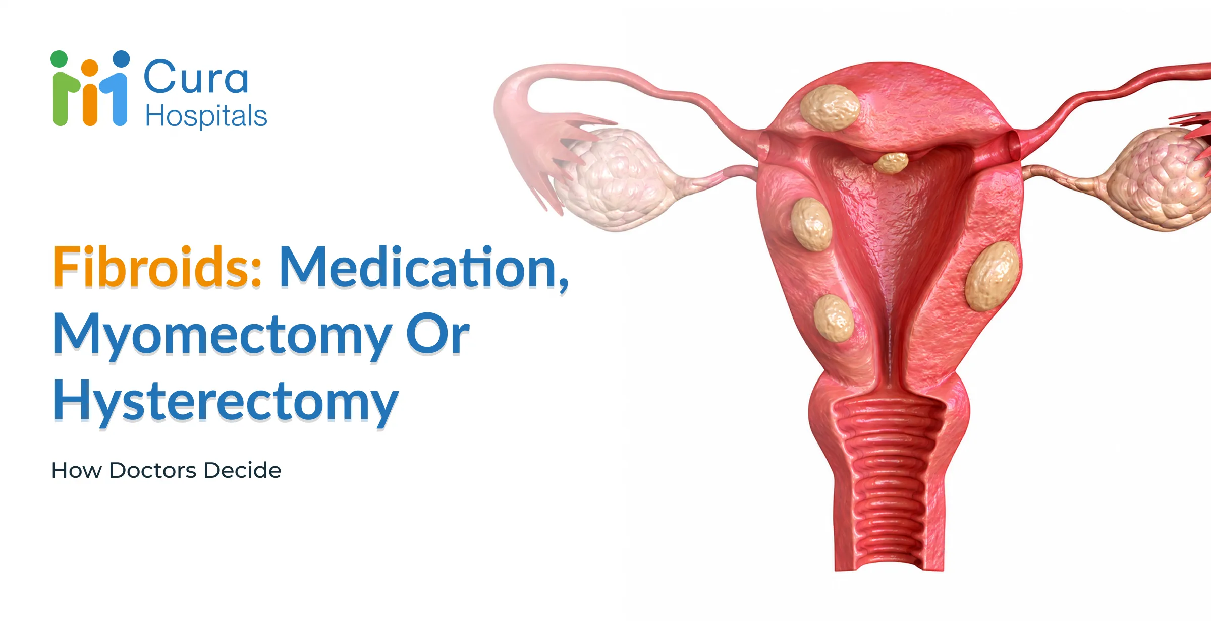 Fibroid Treatment: Medication, Myomectomy or Hysterectomy