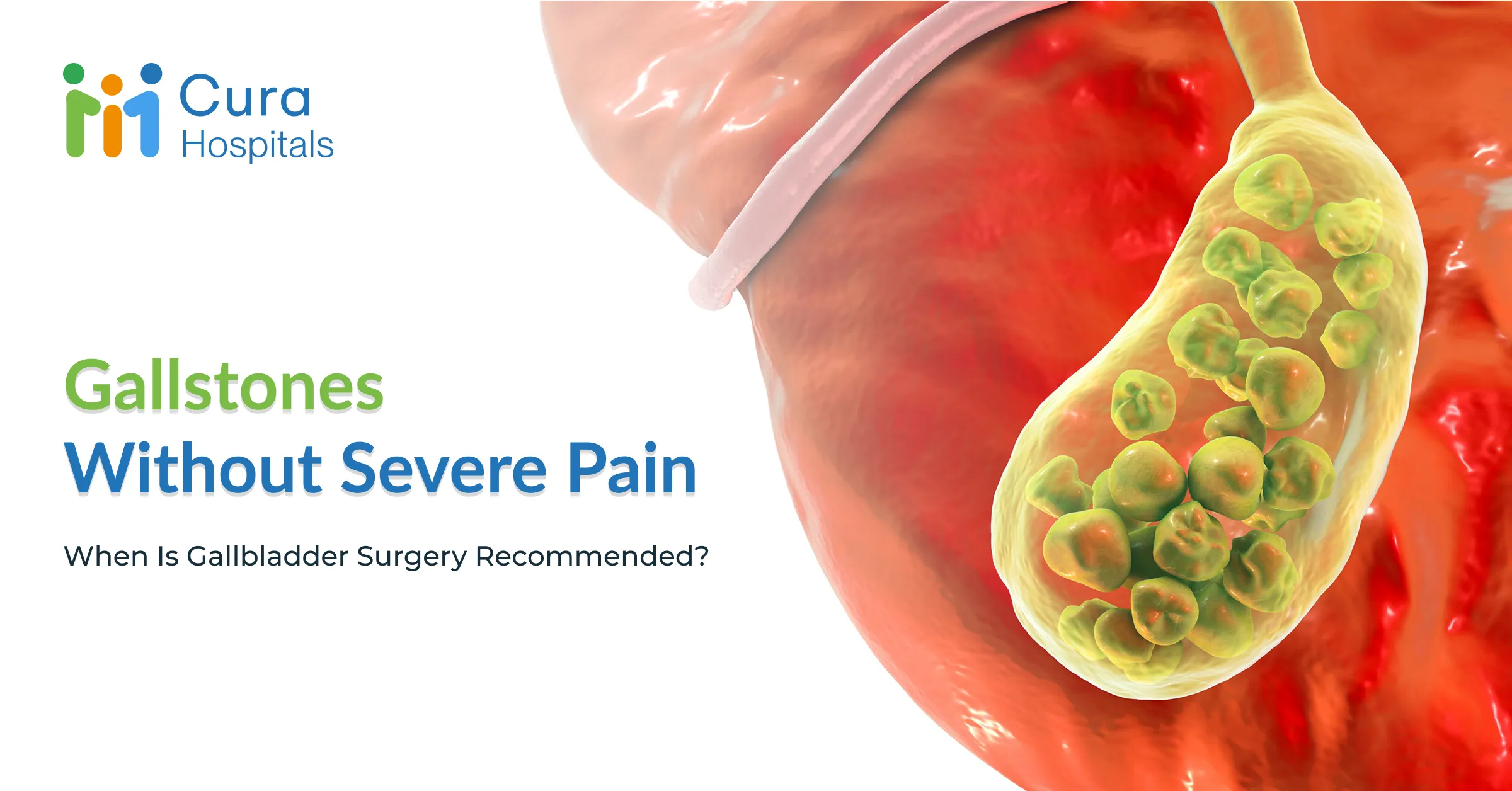 Gallstones Without Severe Pain: When Is Gallbladder Surgery Recommended?