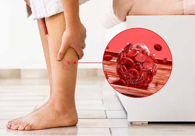 Deep Vein Thrombosis
