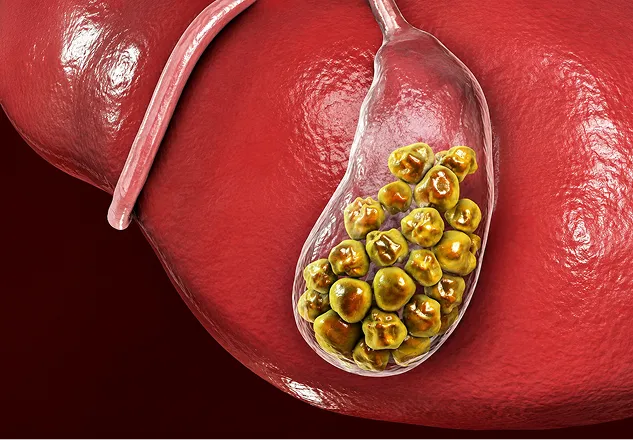 Gallstones