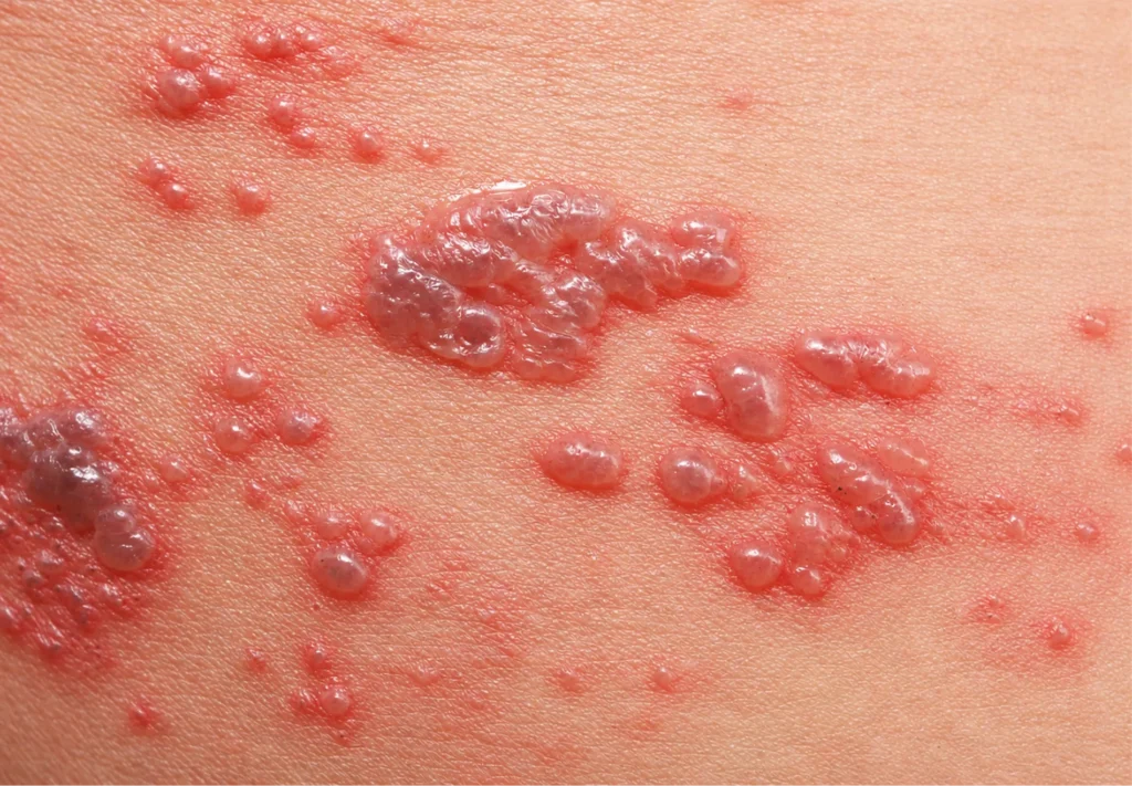 Shingles