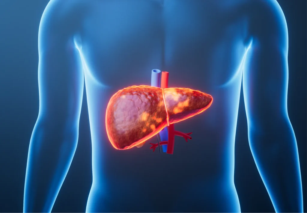 Cirrhosis