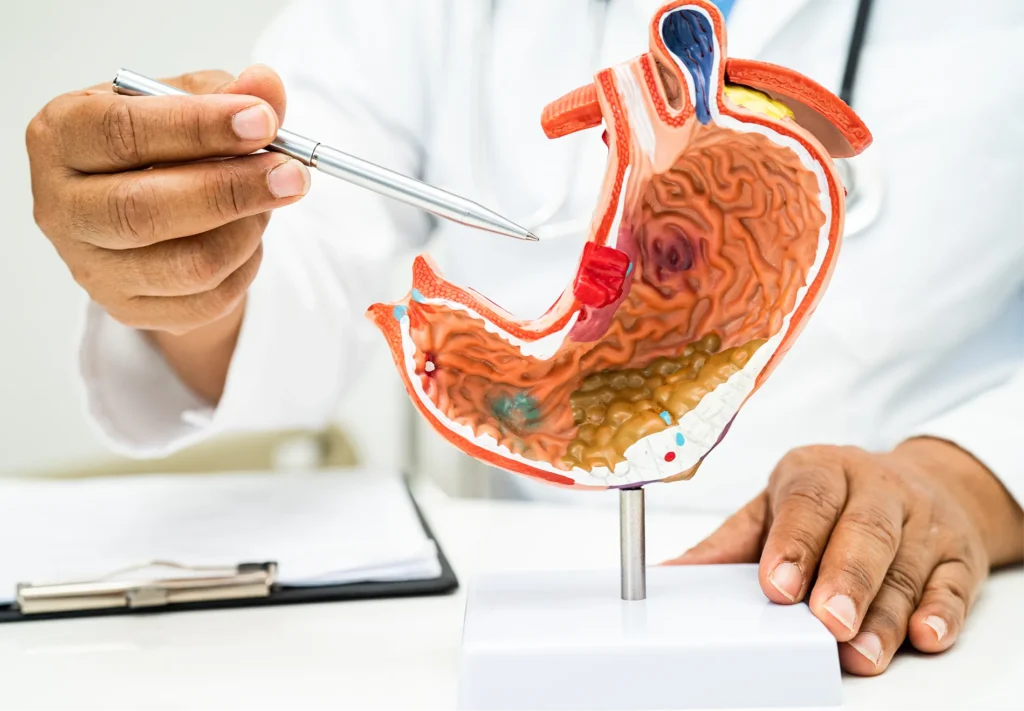 Stomach Cancer