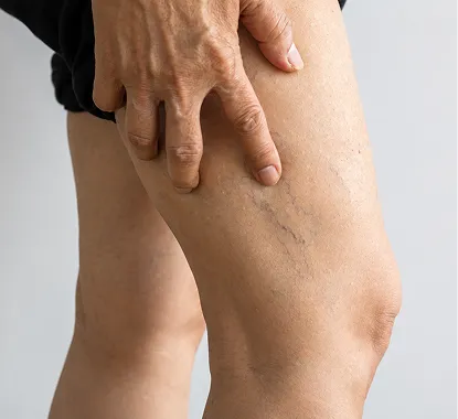 Proximal DVT: