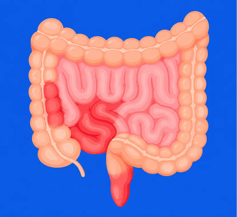 Ileocolitis: 