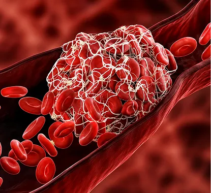 DVT associated with pulmonary embolism: 
