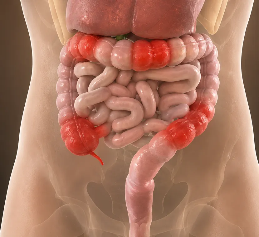 Gastroduodenal Crohn's Disease: 